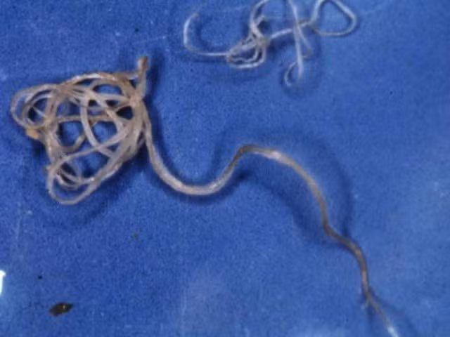 Ký sinh trùng giun Filarial có hình tròn, nhỏ như sợi chỉ, nhưng có sức mạnh đáng sợ vô cùng. Chúng ẩn sâu dưới da, khiến nạn nhân phát ban, sẩn mày đay, và viêm khớp, thậm chí có thể mù mắt.