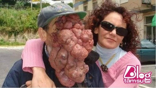 Ông Jose Mestre phải chịu đựng những khối u khổng lồ trên mặt, các khối u này xuất hiện do những bất thường trong mao mạch và tĩnh mạch. Người ta thậm chí không thể nhìn thấy mắt, mũi, miệng của ông, vì thế mà ông thường được gọi là "người không mặt".