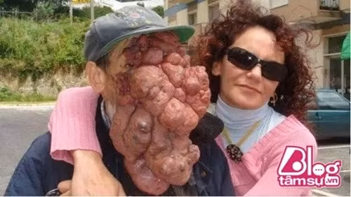 Ông Jose Mestre phải chịu đựng những khối u khổng lồ trên mặt, các khối u này xuất hiện do những bất thường trong mao mạch và tĩnh mạch. Người ta thậm chí không thể nhìn thấy mắt, mũi, miệng của ông, vì thế mà ông thường được gọi là "người không mặt".