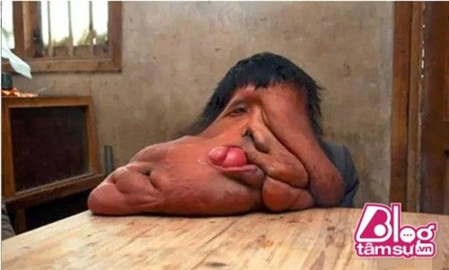 Người đàn ông này trở thành "quỹ dữ" vì mắc căn bệnh hiếm gặp có tên Neurofibromatosis - một bệnh di truyền có nguy cơ cao của sự hình thành khối u ở dây thần kinh, đặc biệt trong não. Vì khối u ngày càng trở nên quá lớn, che lấp con mắt bên trái, làm biến dạng khuôn mặt khiến người đàn ông này không thể ăn uống như người bình thường.