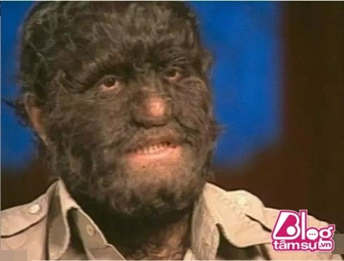 Hypertrichosis là hội chứng xuất phát bởi sự tăng trưởng quá mức của lông trên cơ thể. Những người mắc Hypertrichosis bẩm sinh cực kỳ hiếm và họ thường được gọi là "người sói".