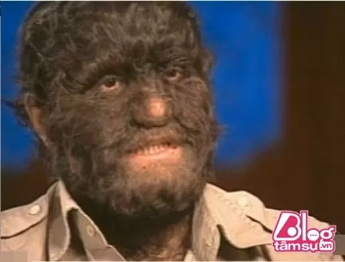 Hypertrichosis là hội chứng xuất phát bởi sự tăng trưởng quá mức của lông trên cơ thể. Những người mắc Hypertrichosis bẩm sinh cực kỳ hiếm và họ thường được gọi là "người sói".