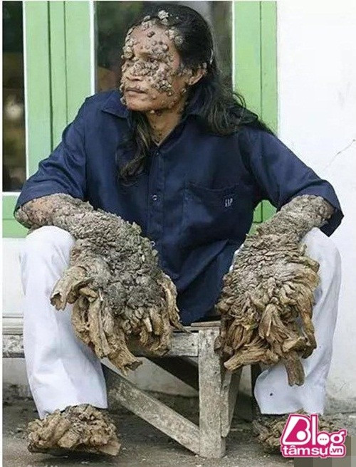 Người đàn ông tên Dede ở Indonesia này đã chẳng may mắc chứng bệnh HPV, một gen “lỗi” hiếm gặp đã tàn phá hệ miễn dịch, khiến cho cơ thể anh mọc những chiếc “rễ cây” ở cánh tay và cẳng chân, sau đó lan dần ra khắp người.