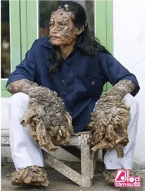 Người đàn ông tên Dede ở Indonesia này đã chẳng may mắc chứng bệnh HPV, một gen “lỗi” hiếm gặp đã tàn phá hệ miễn dịch, khiến cho cơ thể anh mọc những chiếc “rễ cây” ở cánh tay và cẳng chân, sau đó lan dần ra khắp người.