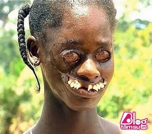Em bé châu Phi này bị là em bé mặt quỷ do chẳng may mắc bệnh viêm miệng hoại tử để lộ ra lợi và hàm răng mọc lệch lạc, nghiêng ngả. Căn bệnh này còn được gọi là Noma, biểu hiện là một vết loét nướu gây biến dạng nghiêm trọng có thể biến đến hoại tử của miệng và mặt, nó lan nhanh chóng thông qua các mô. Hầu hết những người mắc bệnh Noma trong độ tuổi từ một đến sáu.