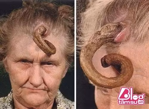 "Người mọc sừng" là những người bị mọc sừng trên đỉnh đầu, mọc sừng sau gáy, mọc sừng ở tai và thậm chí là mọc nhiều sừng. Người phụ nữ bị coi như "dị nhân" vì mọc một chiếc sừng trên đầu.