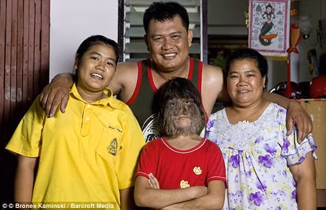 Sau khi xuất viện lúc 10 tháng tuổi, suốt những năm đầu đời, cô gái Thái Lan thường xuyên đối diện những ánh mắt tò mò, e ngại từ người xung quanh.