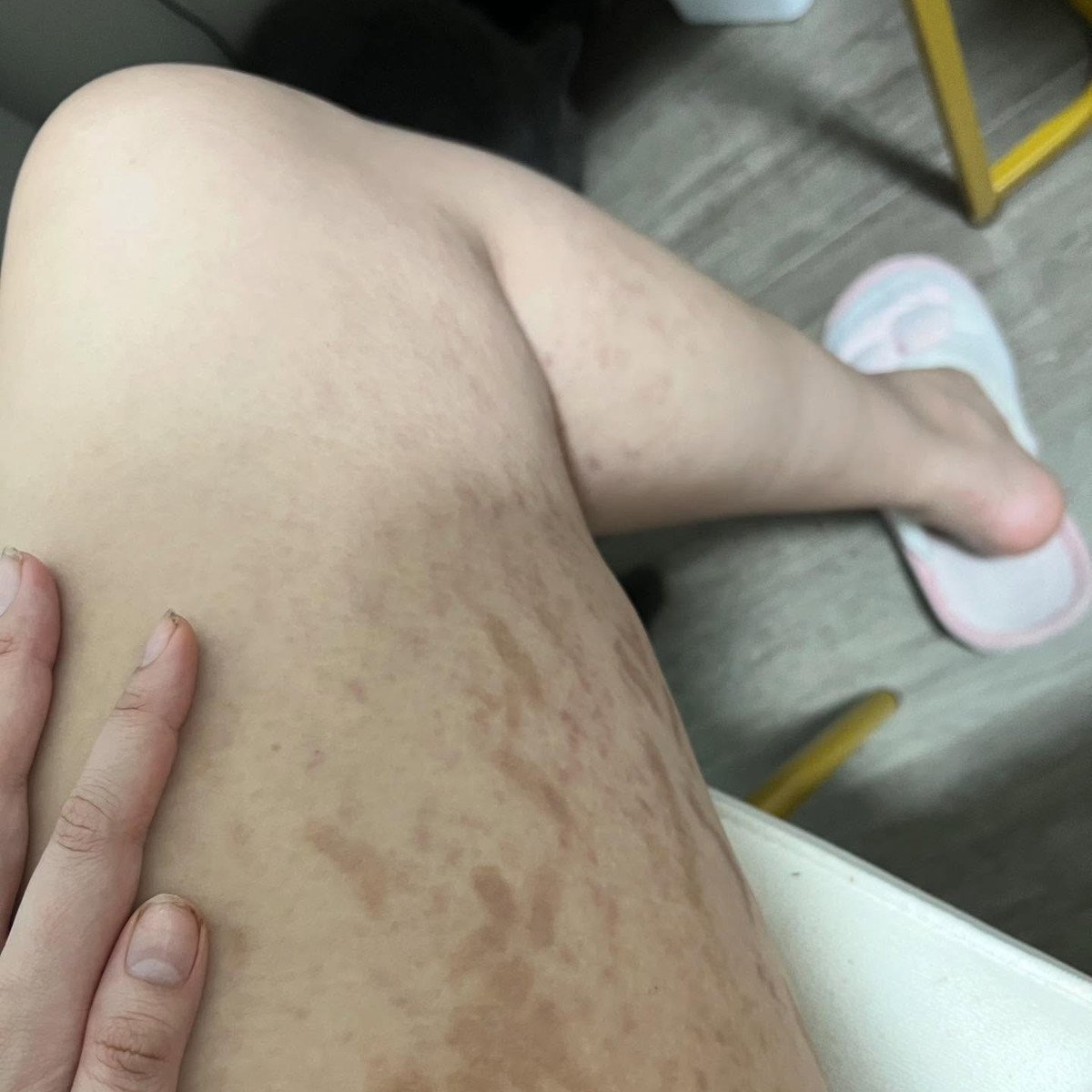 Vì tăng cân đột ngột, thế nên Trúc Anh gặp những vấn đề như rạn da nghiêm trọng, rụng tóc, mụn...