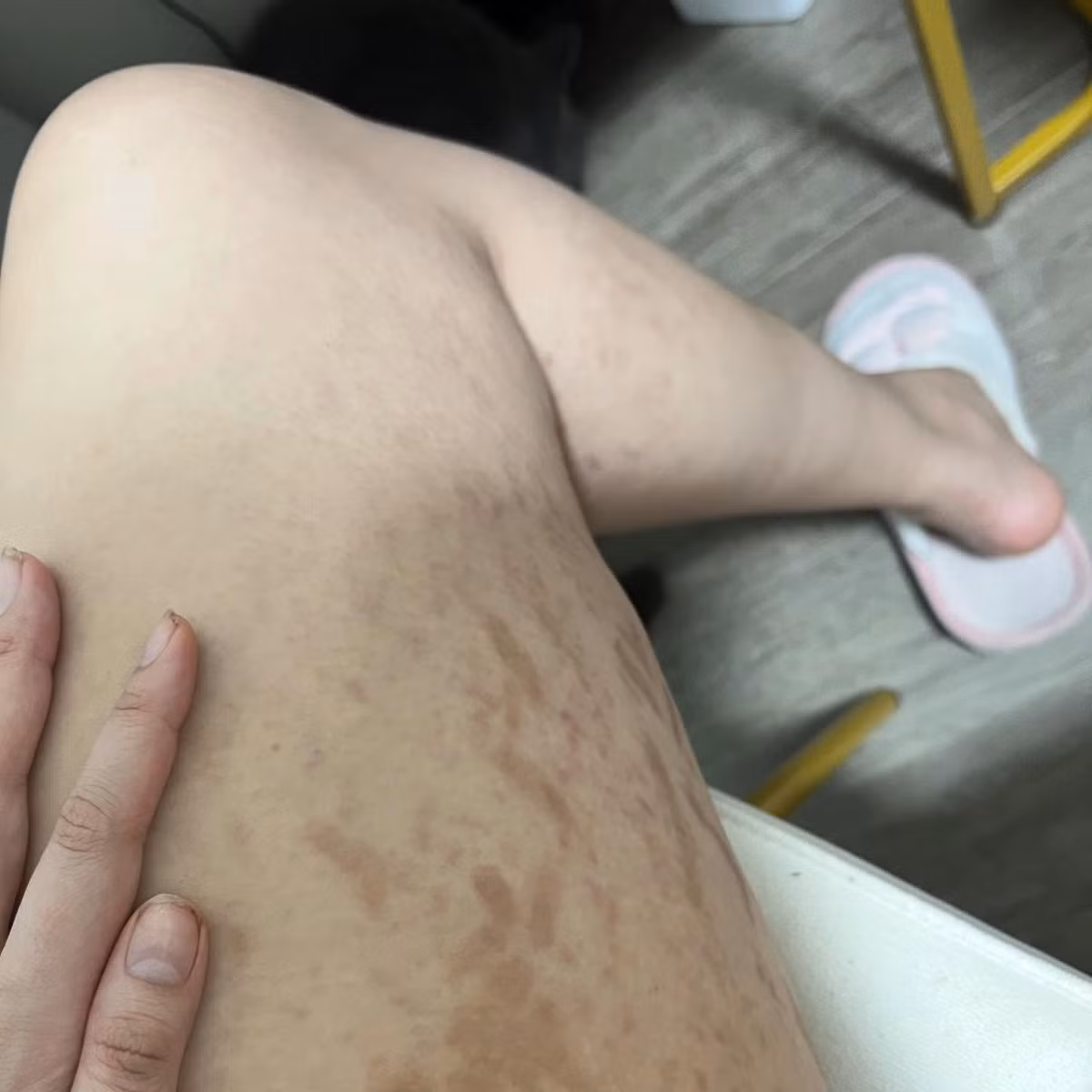 Vì tăng cân đột ngột, thế nên Trúc Anh gặp những vấn đề như rạn da nghiêm trọng, rụng tóc, mụn...