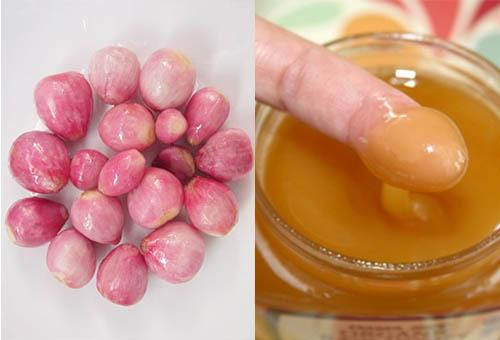 2. Cách trị sẹo thâm lâu năm bằng hành tím: Nguyên liệu cẩn chuẩn bị: 3 củ hành tím, 3 muỗng cafe mật ong nguyên chất 2. Cách trị sẹo thâm lâu năm bằng hành tím: Nguyên liệu cẩn chuẩn bị: 3 củ hành tím, 3 muỗng cafe mật ong nguyên chất