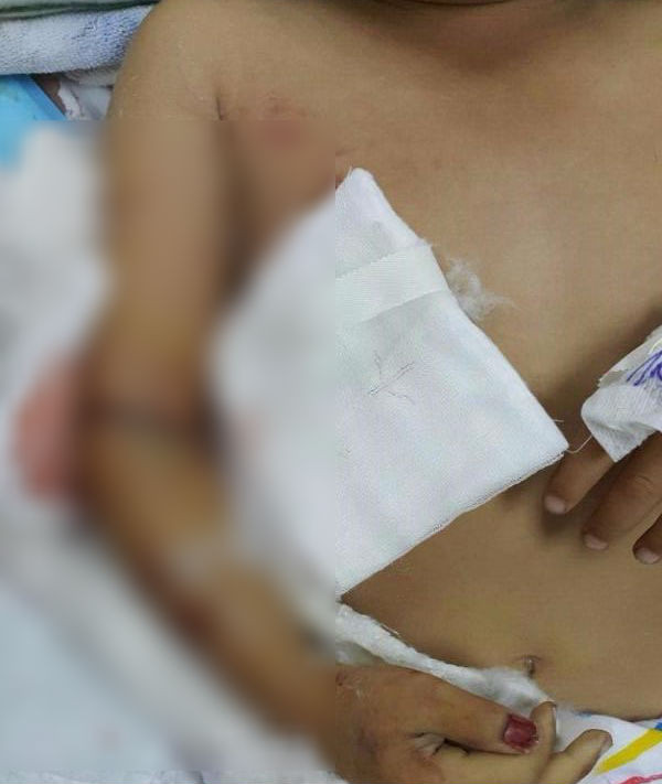  Nhặt dép trên băng chuyền, bé trai bị cắt lìa tay: Bé trai 5 tuổi ở Kiên Giang theo mẹ tới xưởng sản xuất bao nhựa. Trong lúc chơi đùa, chiếc dép bé trai bị rơi vào băng cuốn nên đã với tay lấy. Không may, tay phải của bé bị mắc vào băng cuốn. Trong chốc lát, cánh tay phải bé trai bị kẹp đứt. Xác định bệnh nhi bị đứt lìa 1/3 cánh tay phải, các bác sĩ đã phẫu thuật nối lại cho bé. Tuy nhiên, chỉ thời gian ngắn sau, nhận thấy cánh tay bị tổn thương có dấu hiệu hoại tử, tắc chi, các bác sĩ dù cố gắng nhưng không thể giữ được cánh tay của bé, đã buộc phải đoạn bỏ để giữ tính mạng cho bệnh nhi.