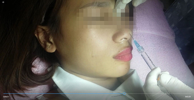 Chị Loan được bà H. tiêm filler.