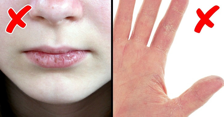 1. Da khô và bong tróc: Dấu hiệu này thường xuất hiện sau tuổi 25. Nếu da bạn xuất hiện nhiều cùng với đốm và nếp nhăn thì hãy cẩn thận.