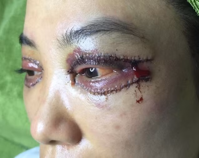Mí mắt của cô gái khi mới cắt mí, vết cắt gồ ghề, xấu xí và bị nhiễm trùng.
