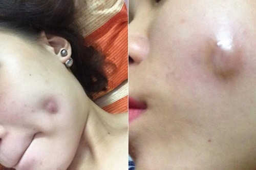 Phẫu thuật tạo má lúm bị hỏng.