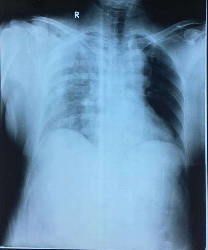 Phẫu thuật cấp cứu thành công bệnh nhân đa chấn thương có nhóm máu hiếm O Rh(-). Phẫu thuật cấp cứu thành công bệnh nhân đa chấn thương có nhóm máu hiếm O Rh(-).