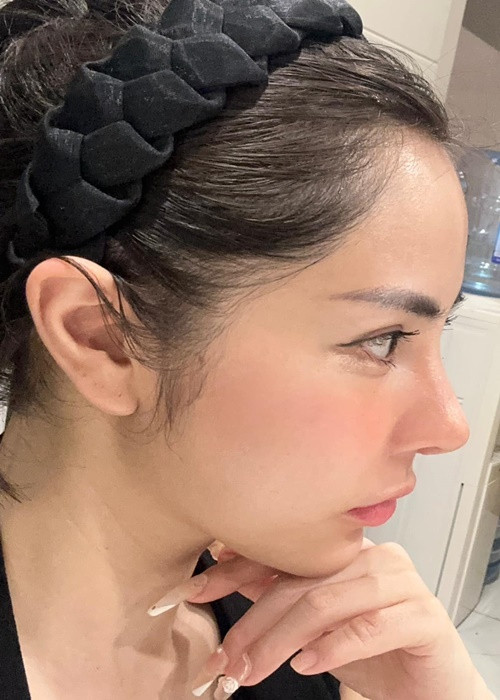 Bạch Lan Phương đăng tải hình ảnh cận cảnh sống mũi sau 10 ngày dao kéo.