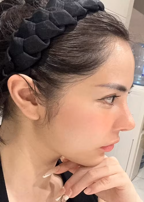 Bạch Lan Phương đăng tải hình ảnh cận cảnh sống mũi sau 10 ngày dao kéo.