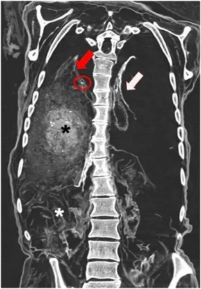 Những vấn đề về sức khỏe trên có thể dẫn tới xuất huyết phổi cấp tính. Nhóm nghiên cứu cho hay đây có thể là nguyên nhân tử vong của cha xứ Rosenegg do không tìm thấy bằng chứng nào về ngộ độc. Ảnh: S. Panzer.