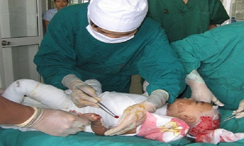 Những trường hợp trẻ bị bỏng do bất cẩn trong sinh hoạt rất thường gặp. (Ảnh minh họa)