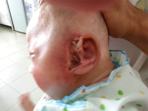 Giòi ăn đứt lỗ tai bé 5 tuổi. Vào năm 2013, các bác sĩ thuộc Bệnh viện Nhi đồng 1 (TP HCM) tiếp nhận 1 bệnh nhi H.U.N (Đăk Lăk) có triệu chứng tai chảy mủ và sưng to. Sau khi tiến hành thăm khám, các bác sĩ đã phát hiện ra có ổ giòi ở tai bé. (Ảnh: Zingnews).