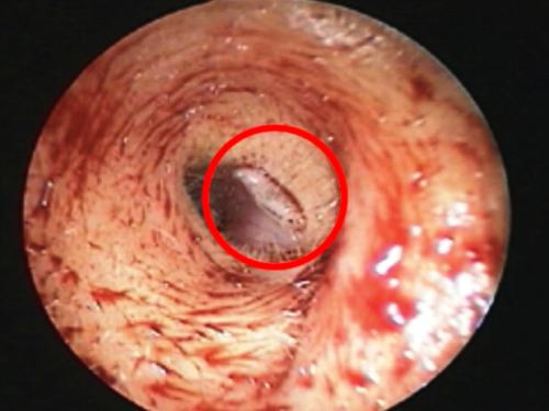 Hồi tháng 2/2014, một phụ nữ 48 tuổi bị lãng tai nhập viện sau khi cảm thấy tai nhức buốt suốt 24 tiếng. Bác sĩ tại Bệnh viện Đa khoa Tri-Service, Đài Bắc, đã tháo bỏ máy trợ thính cô đeo bên tai trái và thấy trong tai bê bết máu. Kiểm tra, họ nhận thấy ấu trùng ruồi giấm đang di chuyển xung quanh ống tai bệnh nhân. Nó đã ở trong tai cô ít nhất một ngày.