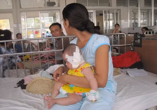 Khi tiến hành phẫu thuật, các bác sỹ đã gắp khoảng 50 con giòi ra khỏi cơ thể bé N. Do phát hiện muộn nên giòi đã ăn len lỏi khắp nơi trong vành tai và ăn mất ống tai. Vành tai bị hoại tử lởm chởm khiến sức nghe của bé N giảm từ 20 đến 40%. (Ảnh:Tinmoi).