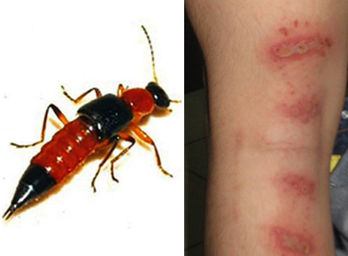 Bôi kem phenaegan (8-10 lần một ngày). Chú ý khi bôi thuốc phải miết mạnh ở vùng da bị đốt đến khi thuốc khô, thẩm thấu thuốc sẽ tốt hơn. Ảnh: Sức Khỏe Đời sống