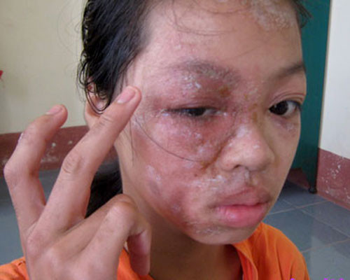 Tự ý bôi thuốc. Trường hợp tổn thương nặng, phù nề nhiều, viêm nhiễm không nên tự ý lấy thuốc bôi, vì da đã bị phỏng rộp bôi thuốc sẽ làm cho tình trạng phỏng rộp nghiêm trọng hơn. Nên đến bác sĩ da liễu để khám và điều trị. Ảnh: Báo Tuổi Trẻ Thủ Đô