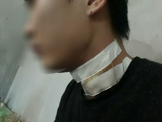 Anh T. phải khâu nhiều mũi sau pha cứa cổ của hai thanh niên. Nguồn ảnh: Zing
