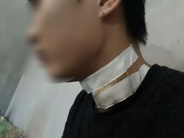 Anh T. phải khâu nhiều mũi sau pha cứa cổ của hai thanh niên. Nguồn ảnh: Zing