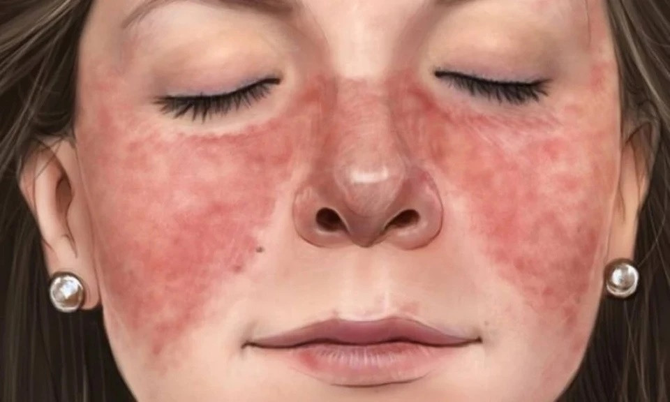 Má đỏ: Theo WebMD, bạn có thể đỏ mặt do bối rối, sốt, dùng thuốc và một số lý do khác nhưng nếu mặt bạn thường xuyên đỏ, đây là dấu hiệu của tình trạng sức khỏe khác. Các nguyên nhân có thể bao gồm tình trạng da phổ biến như bệnh hồng ban và viêm da tiết bã, viêm da dị ứng hay bệnh lupus, ảnh hưởng đến các cơ quan khác trong cơ thể bạn. Lupus có thể biểu hiện bằng phát ban hình con bướm ở mũi và má. Ảnh: Healthjade.