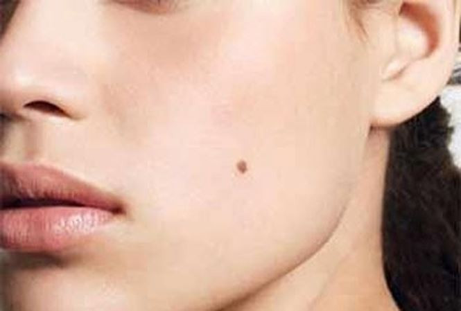 Cuc ky nguy hiem khi bi ung thu tu ... not ruoi