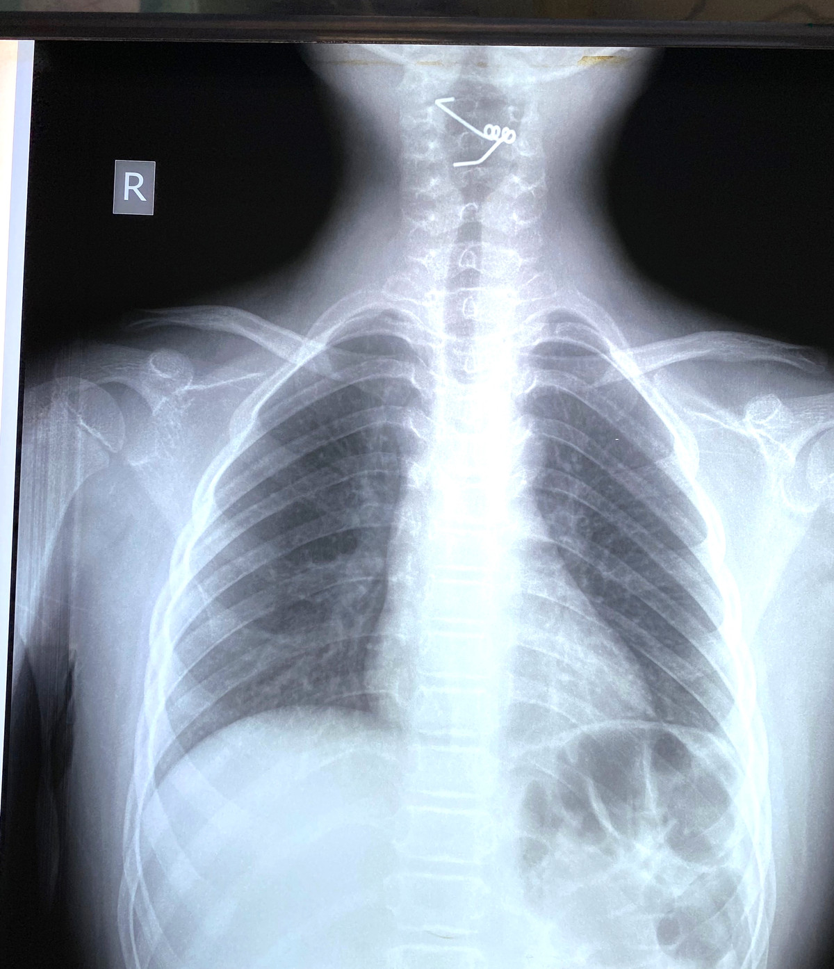 Kinh hai chuyen be trai 9 tuoi tu nhet lo xo vao co hong