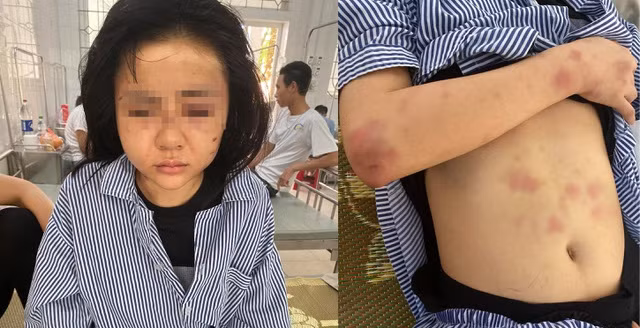 Thieu nu Yen Bai bi nguoi tinh bao hanh: Diem mat nhung ke cuong yeu bien thai-Hinh-2