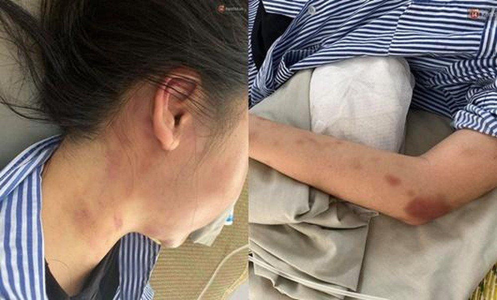 Tối 31/5, sau khi chị L. cùng bạn đi ăn rồi trở về nhà trên đường Hoàng Liên Sơn, thuộc địa bàn phường Trung Tâm, T. đã lẻn vào rồi quát tháo, lăng mạ nạn nhân. Không dừng lại, gã thanh niên này còn liên tục đấm, đá túi bụi vào người, vào mặt chị L.