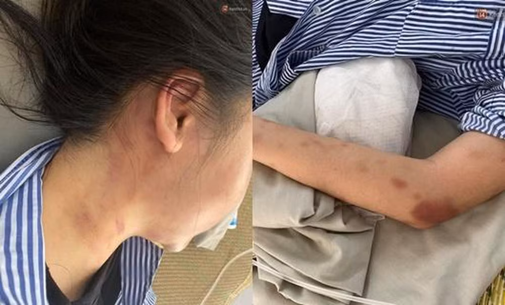 Tối 31/5, sau khi chị L. cùng bạn đi ăn rồi trở về nhà trên đường Hoàng Liên Sơn, thuộc địa bàn phường Trung Tâm, T. đã lẻn vào rồi quát tháo, lăng mạ nạn nhân. Không dừng lại, gã thanh niên này còn liên tục đấm, đá túi bụi vào người, vào mặt chị L.