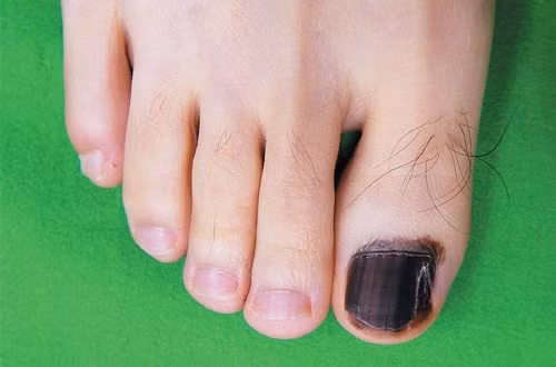 Ung thư dưới móng: Dưới lớp móng tay, móng chân của bạn hoàn toàn có thể trở thành ổ trú ngụ sinh sôi của mầm bệnh ung thư mà bạn không nghĩ tới. Ảnh: Infornet.