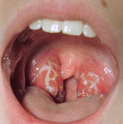 Người bị viêm amidan, sưng hạch cổ: lá thuốc chàm mèo khô, bồ công anh mỗi thứ 15g, huyền sâm 12g tất cả đem sắc lấy nước uống. Ảnh: Vườn thuốc quý.