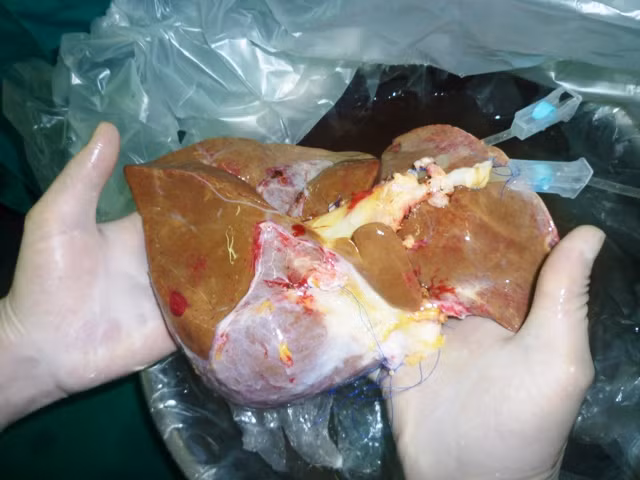 Ghép gan: Kỹ thuật ghép gan các bác sĩ nước ta thực hiện khá nhuần nhuyễn và thành công. Theo thống kê từ 2004 đến nay, mới thực hiện 20 ca ghép gan từ người cho sống và khoảng 40 ca ghép gan từ người cho chết não. Trong khi hiện đang có khoảng 1.500 bệnh nhân chờ đợi ghép gan.