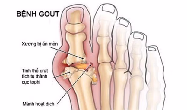 Chữa bệnh gout bằng dừa xiêm và lá trầu không được các bác sĩ của Học viên quân y đánh giá rất cao về độ an toàn và công dụng vượt trội. Ảnh: Diễn đàn sinh viên y khoa.