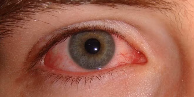 Người bị đau mắt đỏ, viêm kết mạc, sưng, chảy nước mắt…: 20g rễ chàm mèo, 18g bồ công anh, liên kiều, từ hoa địa đĩnh mỗi vị 15g; hoàng cầm 12g; đại hoàng, hoàng liên mỗi vị 10g. Mỗi ngày sắc 1 thang với các vị thuốc đúng theo liều lượng ở trên, chia làm 3 lần uống. Ảnh: Báo mới.