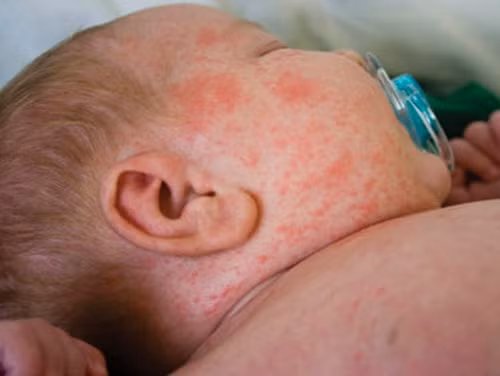 Trị bệnh sởi: lấy các vị thuốc gồm chàm mèo, thiên hoa phấn, kim ngân hoa, huyền sâm, hạnh nhân, tang diệp, mạch môn đông, cam thảo, tiên hồi sắc uống. Ảnh: Sức khỏe tổng quát. 