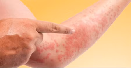 Tính axit trong nước mưa sẽ làm cho da bị dị ứng, mẩn ngứa hay mắc các bệnh như nấm... trong mùa mưa nhiều. Ảnh: Sống khỏe.