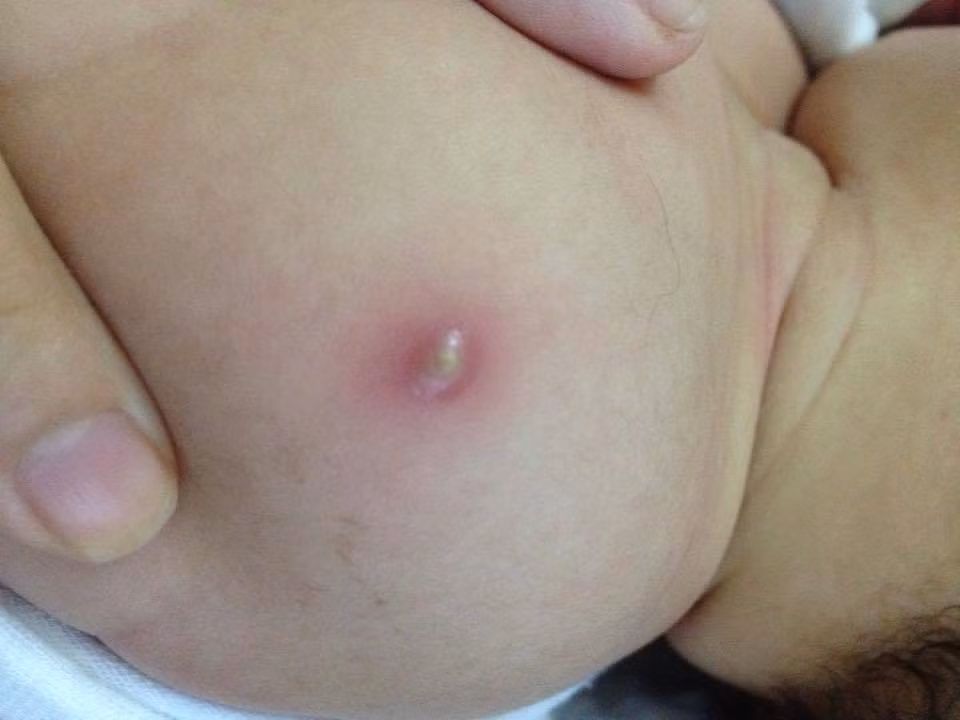 Trị chứng lở loét, mụn nhọt ngoài da: Lấy thân cây chóc gai nấu nước lên tắm, rửa hằng ngày. Ảnh: Cẩm nang sức khỏe.