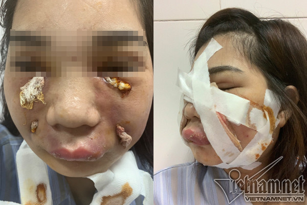 Co gai xinh dep bien dang vi rach mat nan mu sau tiem mo tu than lam dep-Hinh-2