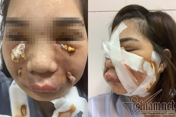 Co gai xinh dep bien dang vi rach mat nan mu sau tiem mo tu than lam dep-Hinh-2