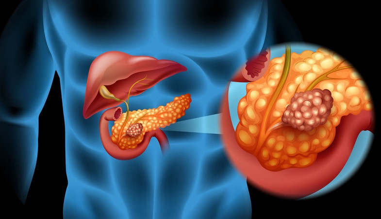 Trieu chung canh bao som ung thu tuyen tuy it nguoi biet