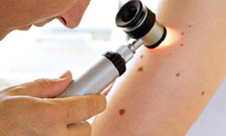 2. Mọc thêm nhiều nốt ruồi, nốt ruồi có dấu hiệu sưng lên: có thể bạn bị ung thư da. Những thay đổi về màu sắc của da như da vàng hoặc trở nên tối màu đều cần phải được lưu ý. Những cơn mẩn ngứa kéo dài. Những thay đổi về màu sắc, kích cỡ, hình dạng của nốt ruồi, tàn nhang, mụn cóc... có thể là dấu hiệu của ung thư da.