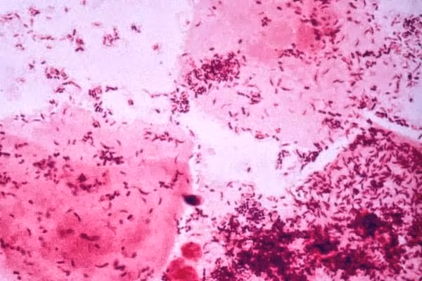 Ngứa âm đạo: Ngứa âm đạo là biểu hiện chính của bệnh viêm âm đạo. Bên cạnh đó bệnh còn có những triệu chứng đi kèm như: ra khí hư nhiều, khí hư bất thường (có màu trắng, xanh, vàng, có bọt, có mùi hôi…). guyên nhân gây bệnh có thể là do nấm, trùng roi, khuẩn lậu, hoặc vi trùng thường…Những phụ nữ đã từng có quan hệ tình dục sẽ có nguy cơ mắc bệnh cao hơn so với nữ giới chưa từng quan hệ.